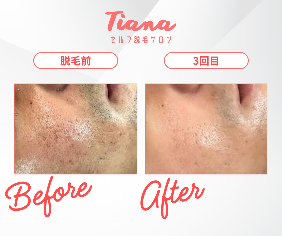 髭脱毛で、清潔感のある印象へ✨