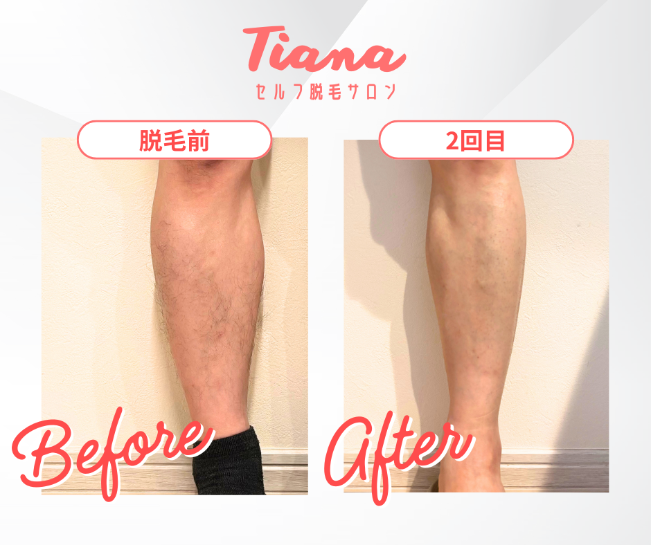 すね毛をすっきり、清潔感のある脚へ