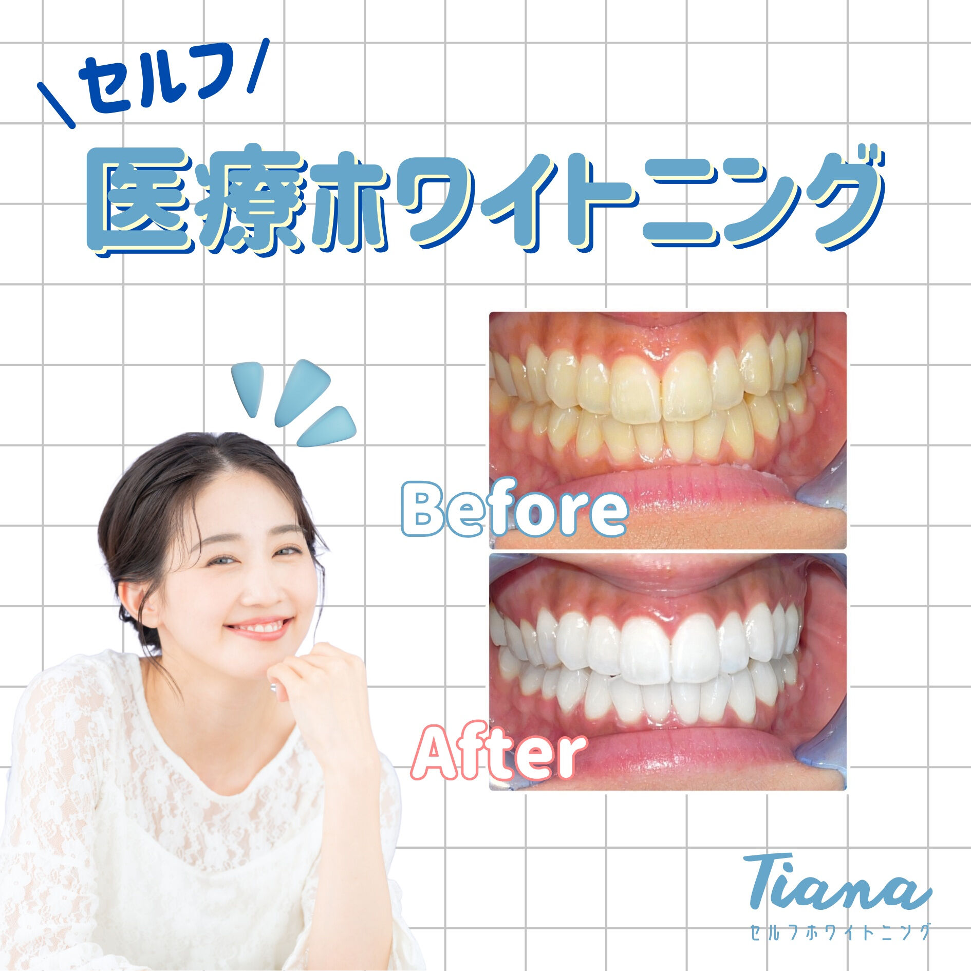🦷✨ セルフで気軽に、白い歯へ